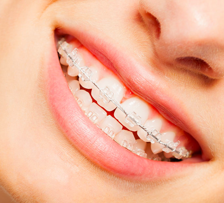 Ceramic braces at Growing Smiles Whitefield Orthodontists in Bangalore