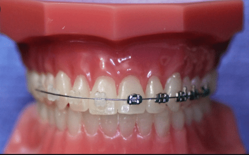 Traditional metal & ceramic braces by Orthodontists in Bangalore at Growing smiles