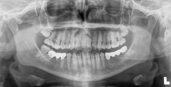 Step 6 - OPG (Full Mouth X-Ray)