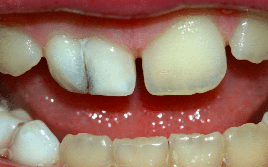 Check for Discoloration & Mobile Milk Teeth