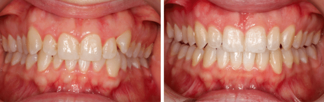My Invisalgn treatment, before and after at Growing Smiles Orthodontics in Bangalore