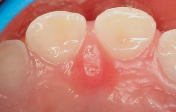 GC Tooth Mousse For Enamel Erosion