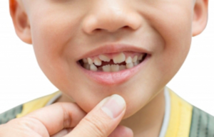 How do Pediatric Dentists Use Fluoride to Help Prevent Dental Caries in Kids