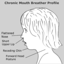 Mouth Breathing Symptoms In Adults