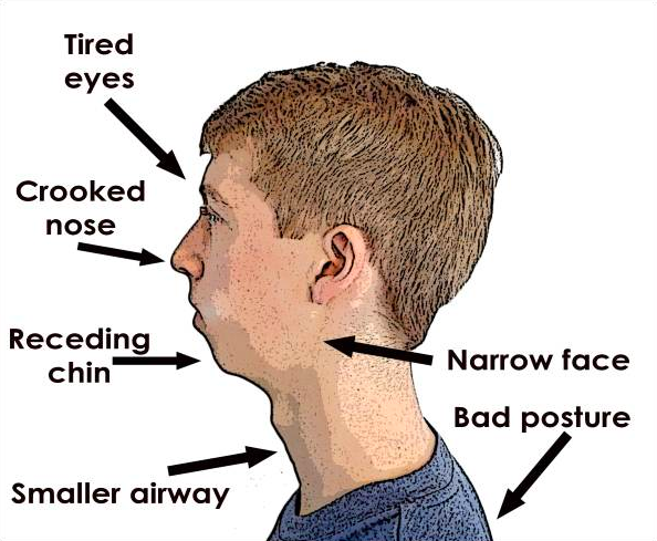 Mouth Breathing Symptoms In Kids