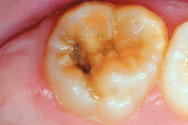 Dental Decay and Cavity