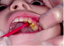 How-is-pediatric-dental-treatment-beneficial-to-young-kids